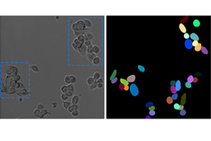 Die linke Abbildung zeigt eine Mikroskop-Aufnahme von Tumor-Zellen. Auf der rechten Seite ist die Segmentierung mittels gängiger Computerprogramme zu sehen. Sobald die Zellen dicht nebeneinander liegen oder überlappen (s. blaue Markierung) verschlechtert sich die Segmentierung. Das vollautomatische Tracking führt daher im Ergebnis zu Ungenauigkeiten.